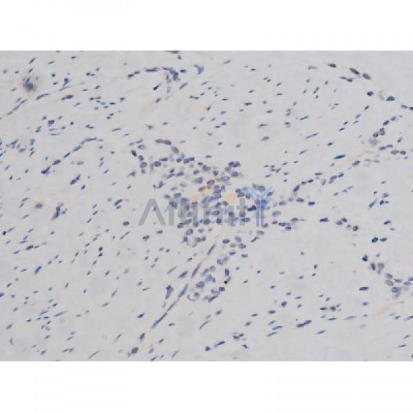 Phospho-Tau (Thr205)[Thr522] Antibody - AF3150 at 1/200 staining Human bladder cancer tissue sections by IHC-P.